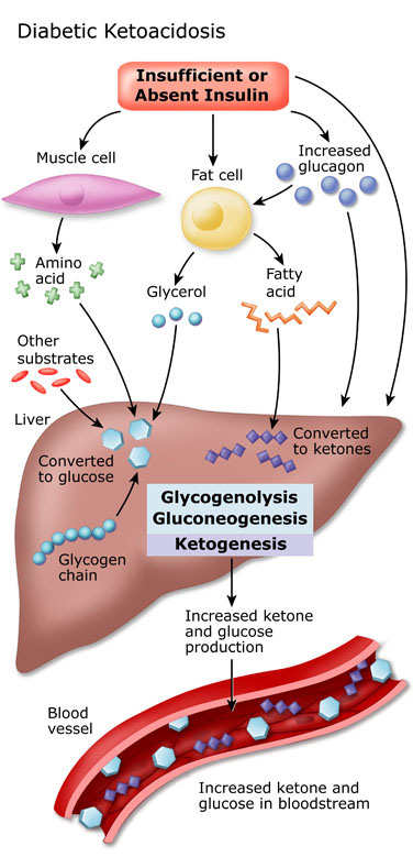 ketoacidosis