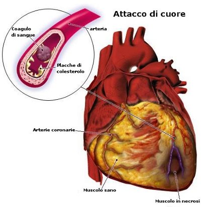 anatomia dell'attacco di cuore2