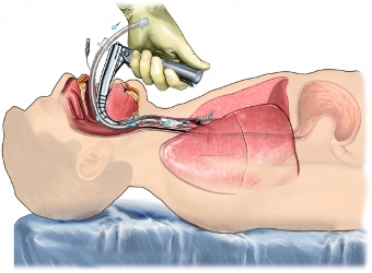 intubation2