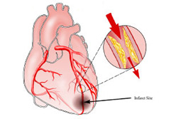 Infarto_miocardio