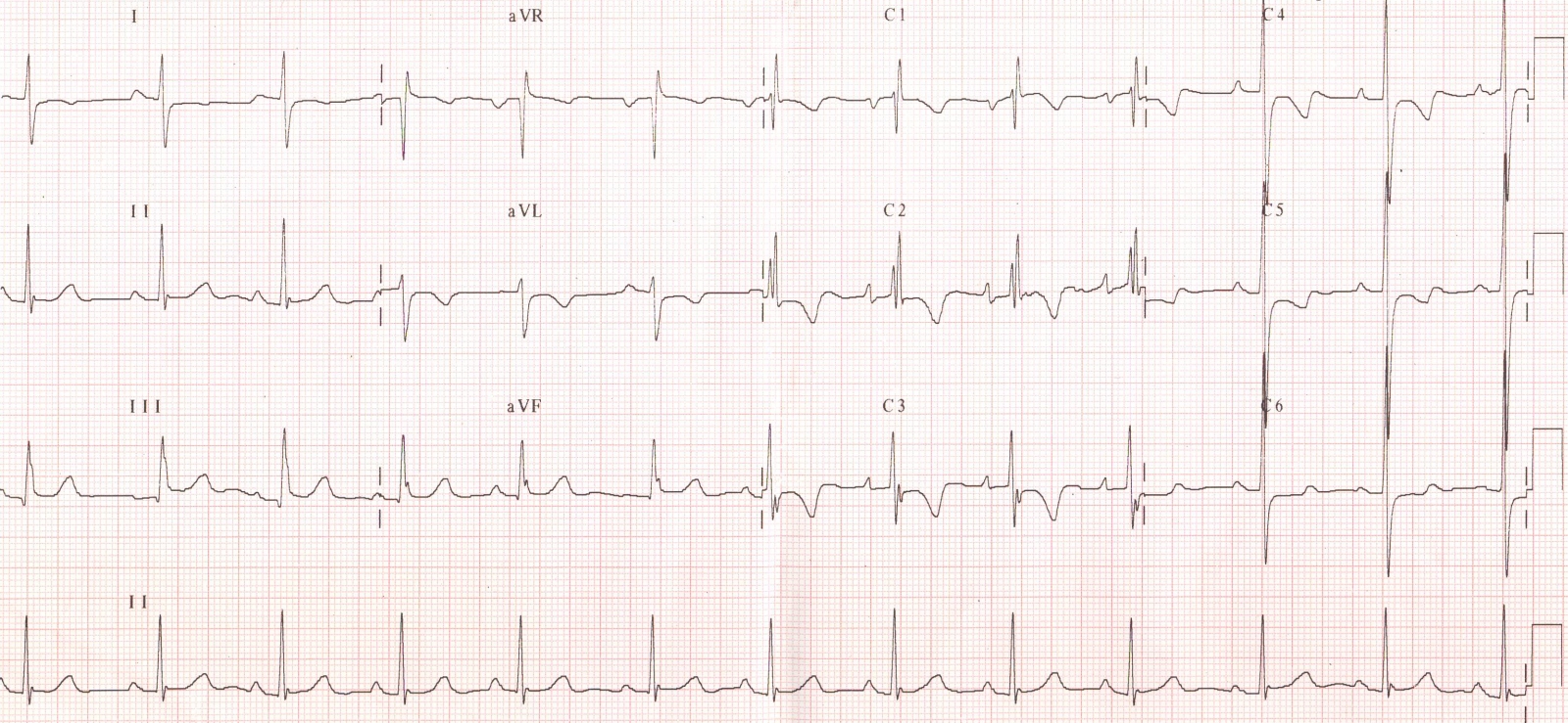 branca ecg