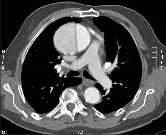 CT Petto: dissezione aortica