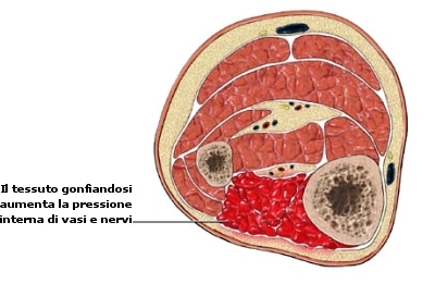 sindrome compartimentale da sforzo