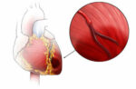 attacco di cuore3