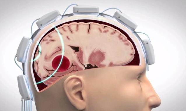 Ictus-un-elmetto-per-diagnosticarlo_h_partb