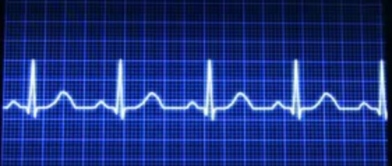 ecg_ev
