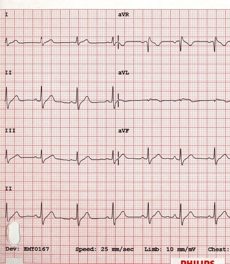 ecg1