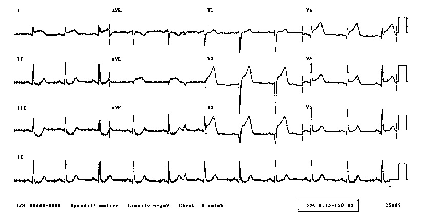 ecg1