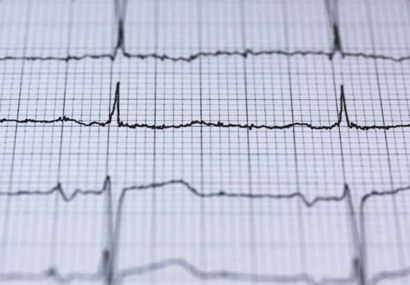 ecg-2270728_1280