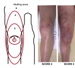 mottling-score-surviving-septic-shock-image-1