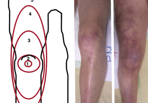 mottling-score-surviving-septic-shock-image-1